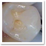 crowns